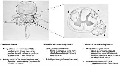 Establishing the Swiss Spinal Tumor Registry (Swiss-STR): a prospective observation of surgical treatment patterns and long-term outcomes in patients with primary and metastatic spinal tumors